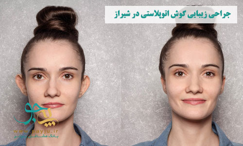 پزشکان جراحی زیبایی گوش اتوپلاستی در شیراز