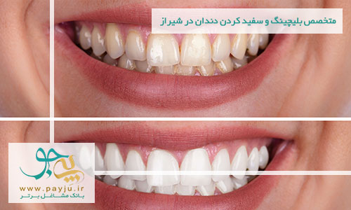 دندانپزشکان متخصص بلیچینگ و سفید کردن دندان در شیراز