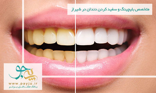 دندانپزشکان متخصص بلیچینگ و سفید کردن دندان در شیراز