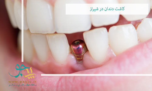 کاشت دندان در شیراز