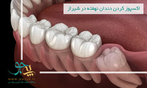 اکسپوز کردن دندان نهفته در شیراز