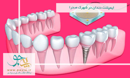 ایمپلنت دندان در شهرک صدرا