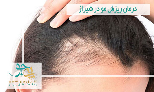 درمان ریزش مو در شیراز