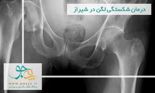 درمان شکستگی لگن در شیراز