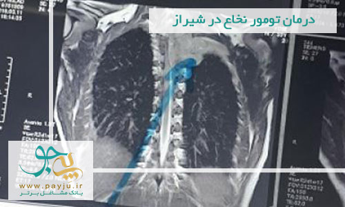 درمان تومور نخاع در شیراز