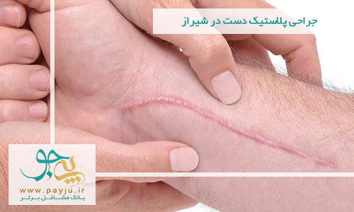 جراحی پلاستیک دست در شیراز جراحی پلاستیک دست در شیراز