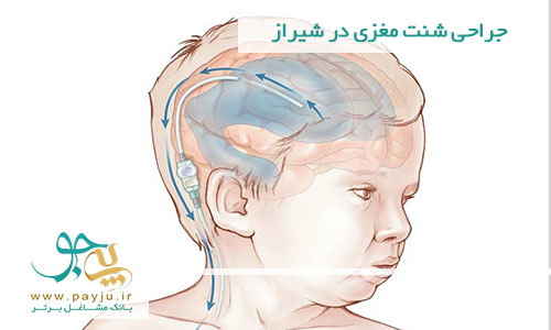 جراحی شنت مغزی در شیراز