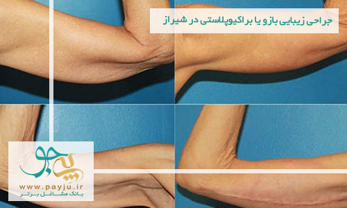 جراحی زیبایی بازو یا براکیوپلاستی در شیراز