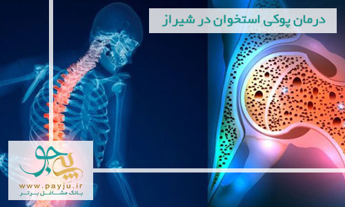 درمان پوکی استخوان در شیراز