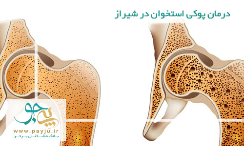 درمان پوکی استخوان در شیراز