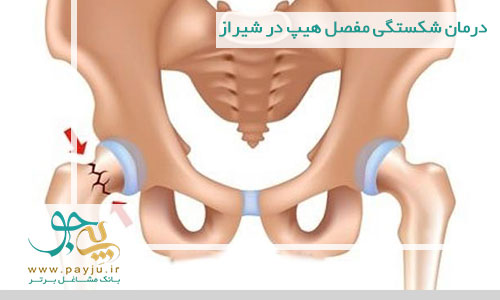 درمان شکستگی مفصل هیپ در شیراز