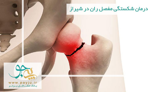 درمان شکستگی مفصل ران در شیراز
