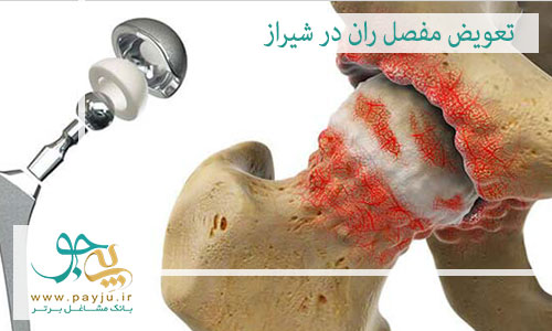 تعویض مفصل ران در شیراز تعویض مفصل ران در شیراز