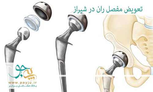 تعویض مفصل ران در شیراز