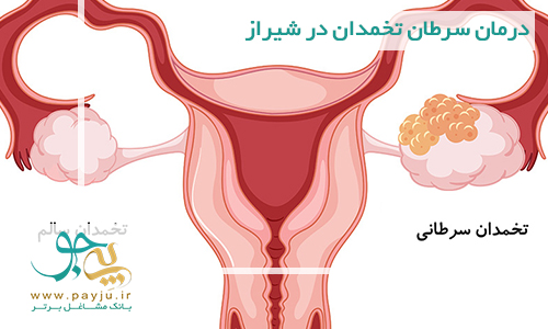 درمان سرطان تخمدان در شیراز