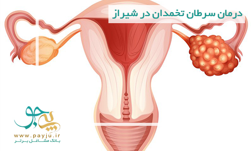 درمان سرطان تخمدان در شیراز