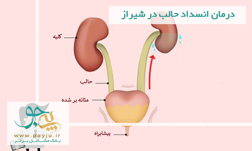 درمان انسداد حالب در شیراز