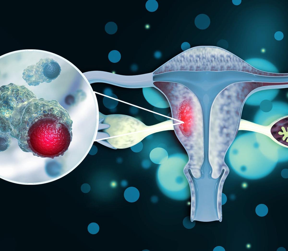 آنچه باید در مورد سرطان زنان بدانید