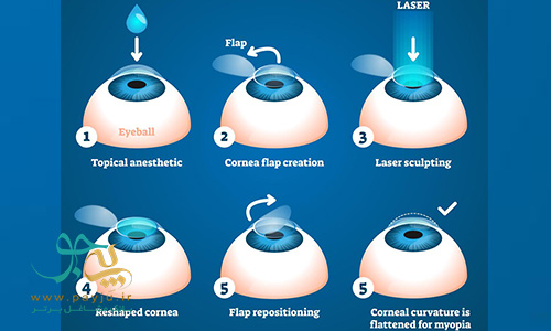 تصویر سازی عمل لیزیک چشم برای رفع عیوب انکساری
