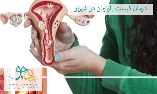 درمان کیست بارتولن در شیراز
